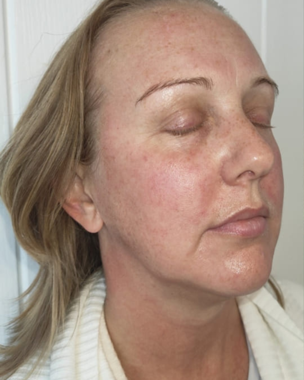 beforeandaftercollagenlift