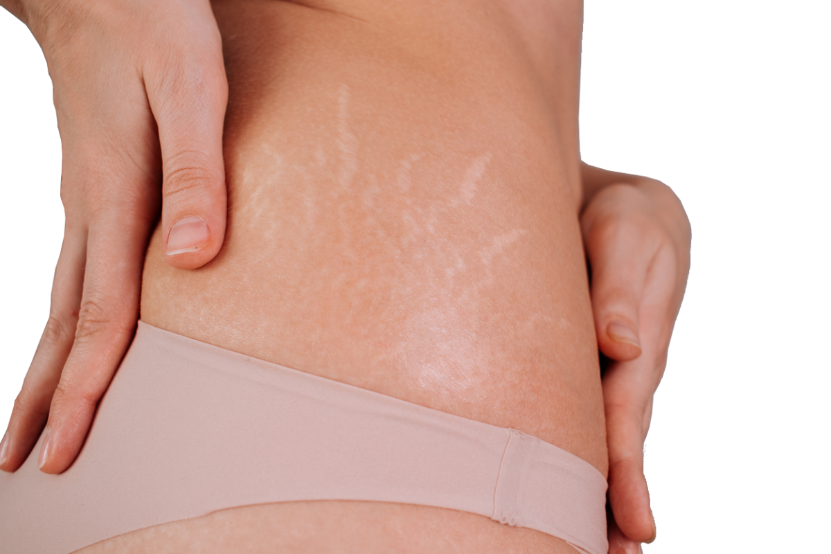 stretch marks