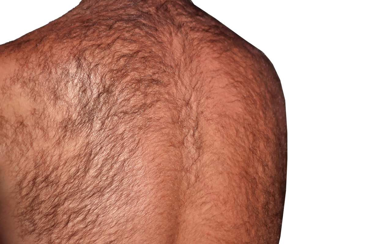 unwanted hair