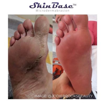 microdermabrasion pedicure