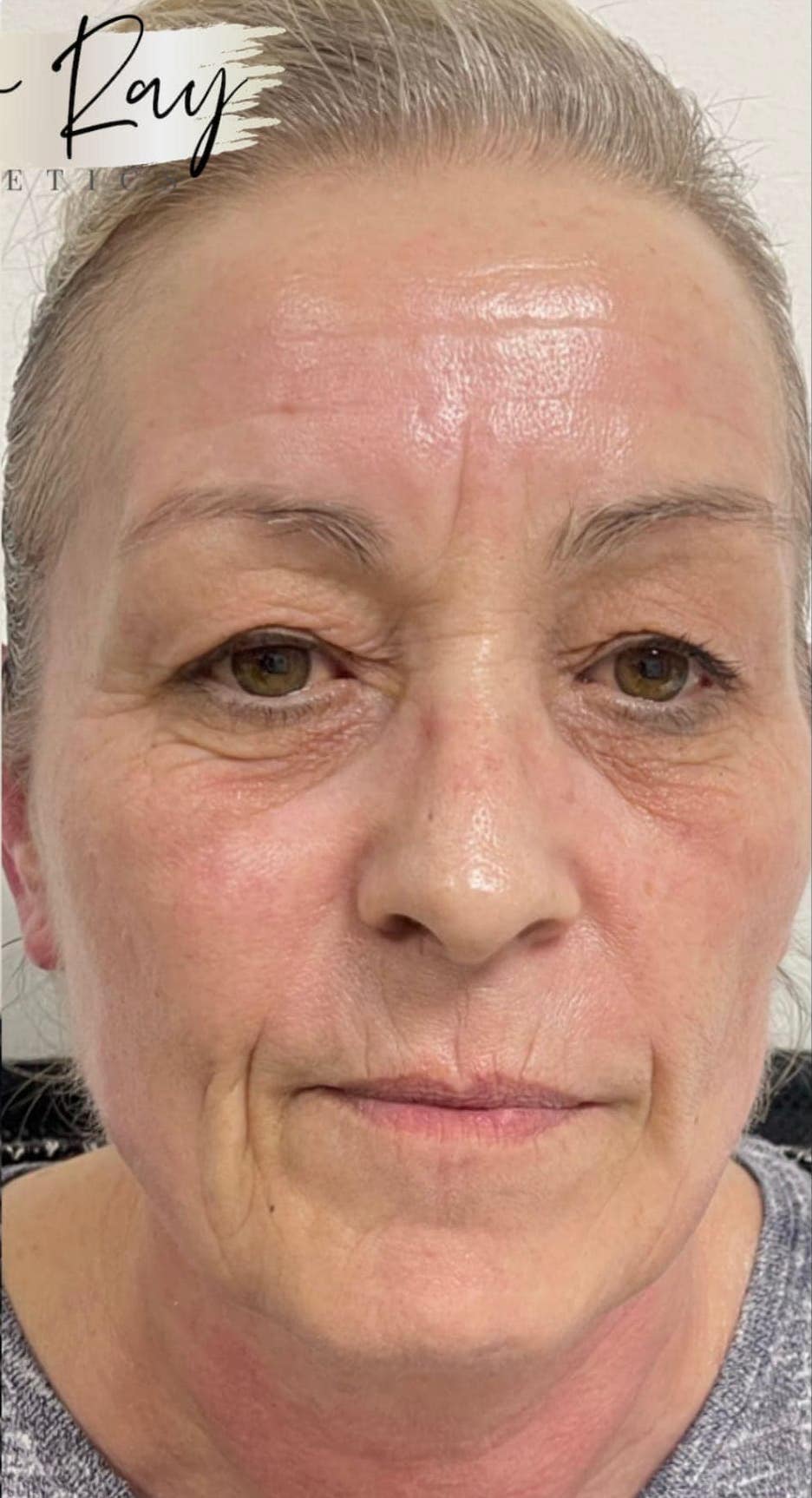 before and after collagen lift amber ray aesthetics