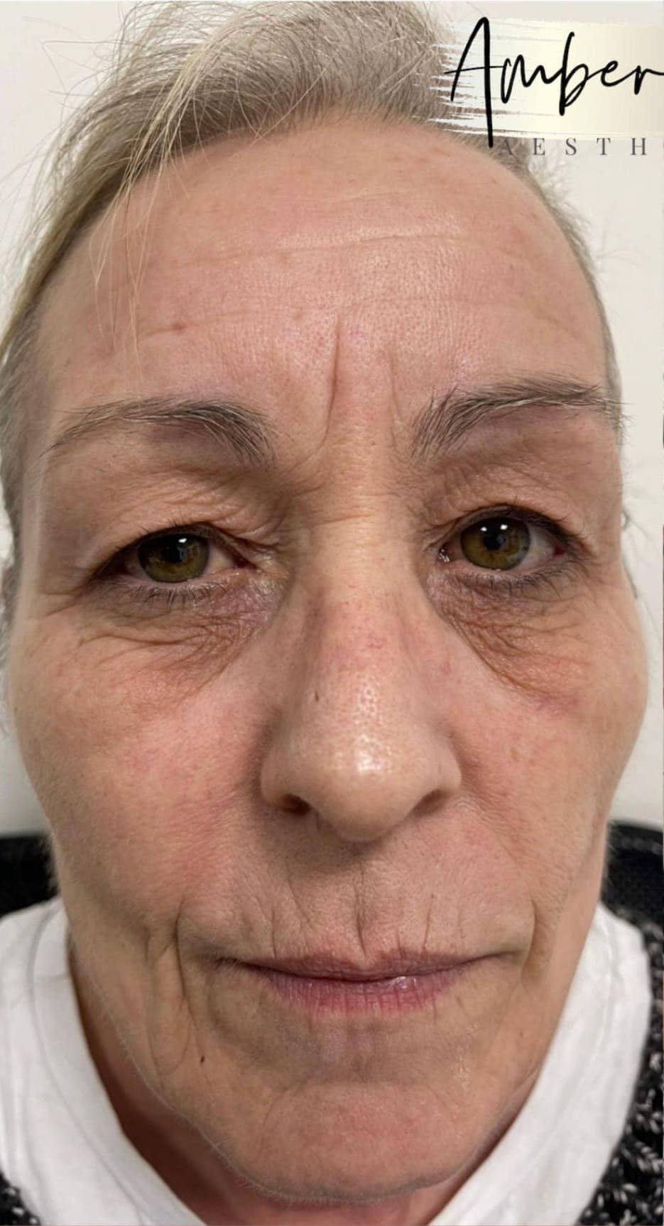 before and after collagen lift amber ray aesthetics