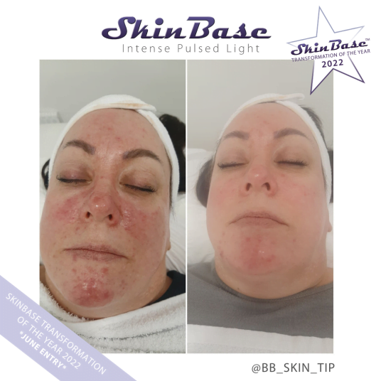 BBSKINTIP