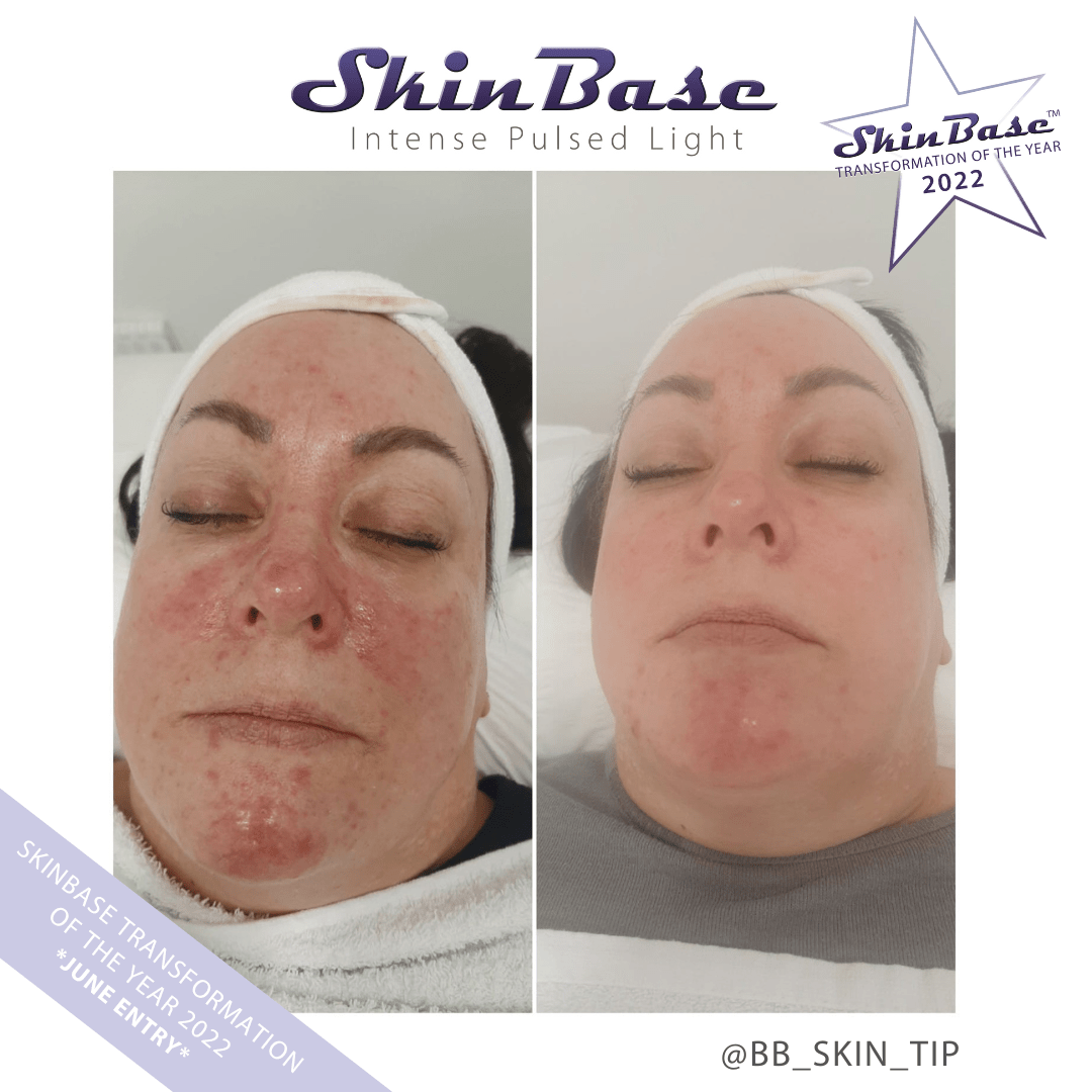 BBSKINTIP