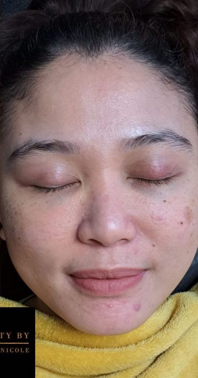 before and after microdermabrasion beauty by holly Nicole