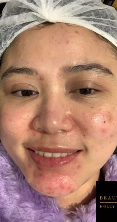 before and after microdermabrasion beauty by holly Nicole