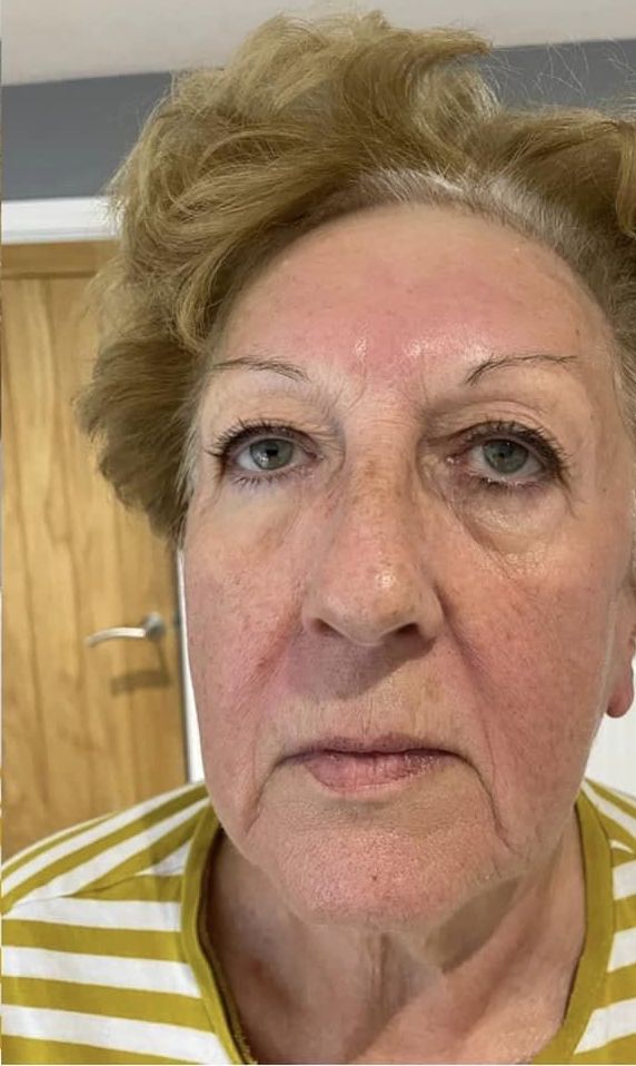 before and after collagen lift beauty by Joanne