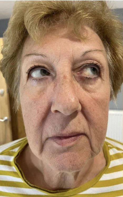 before and after collagen lift beauty by Joanne
