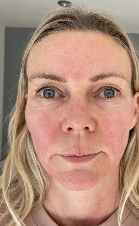 before and after collagen lift beauty by Joanne smedley