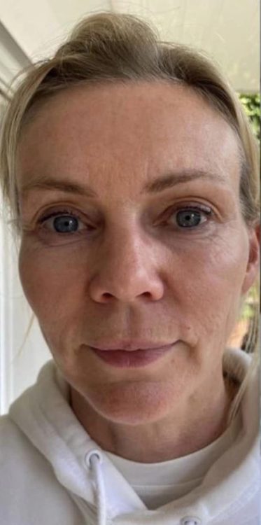 before and after collagen lift beauty by Joanne smedley