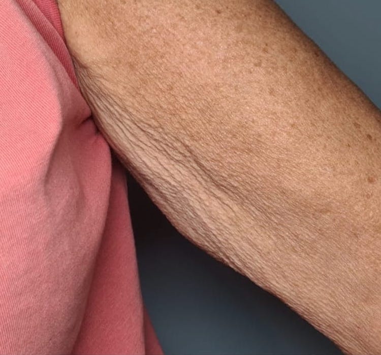 before and after collagen lift becky's beauty and holistics