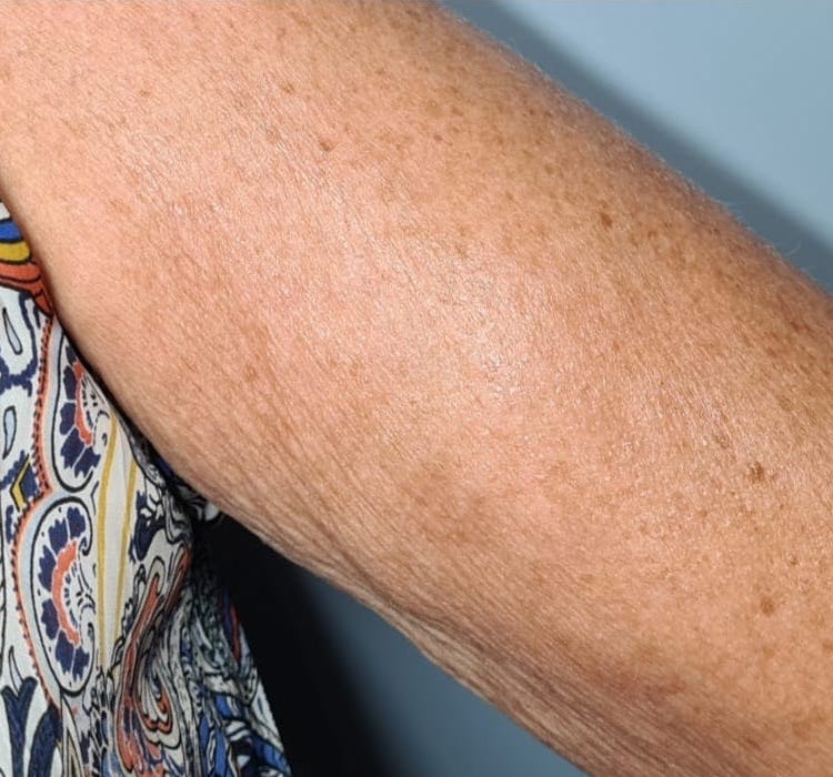 before and after collagen lift becky's beauty and holistics