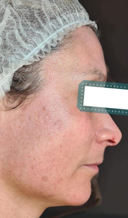 before and after microdermabrasion becky's beauty and holistic