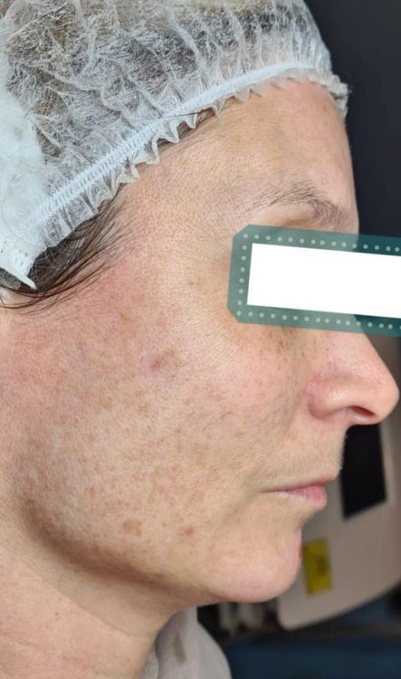 before and after microdermabrasion becky's beauty and holistic