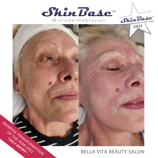 Microdermabrasion Transformation Bella Vita Beauty Salon Microdermabrasion Transformation Bella Vita Beauty Salon