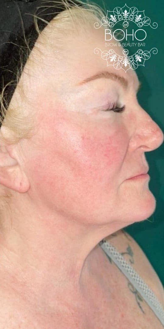 before and after collagen lift boho brow and beauty