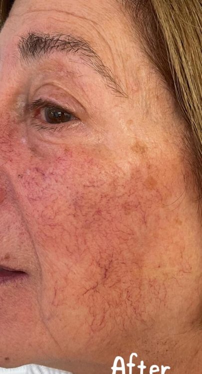 before and after IPL vascular bournville beauty and hair