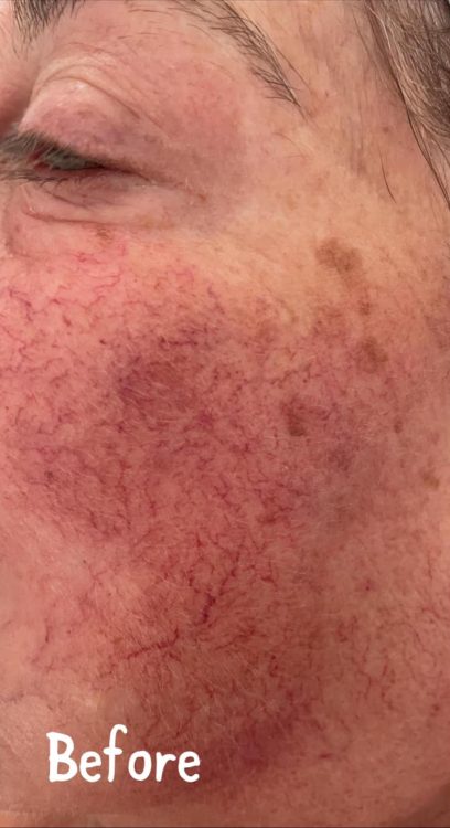 before and after IPL vascular bournville beauty and hair