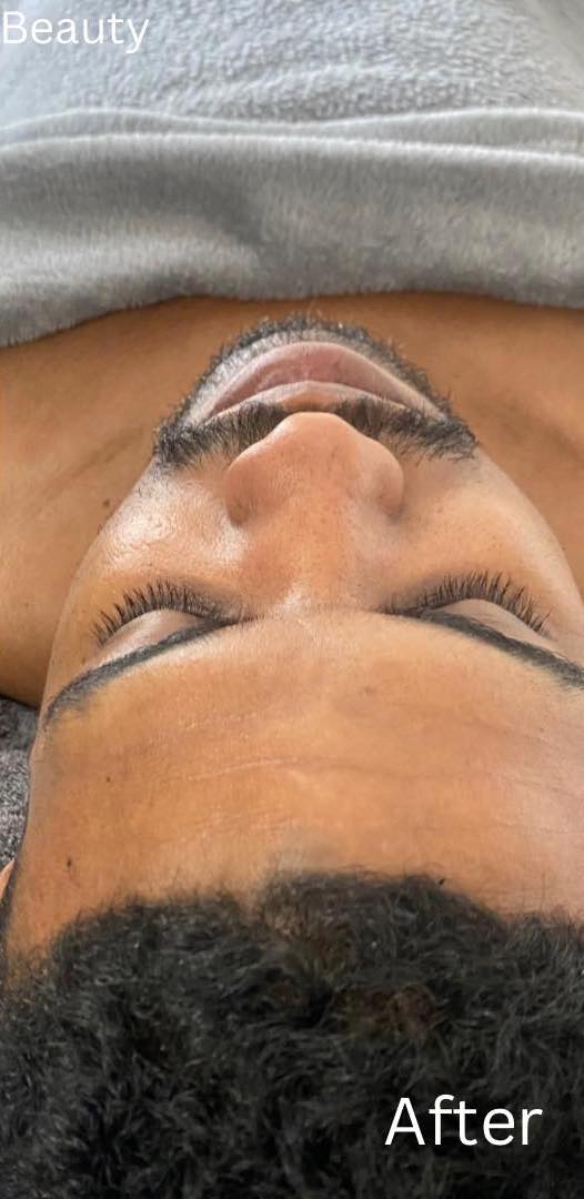 before and after microdermabrasion breathe beauty