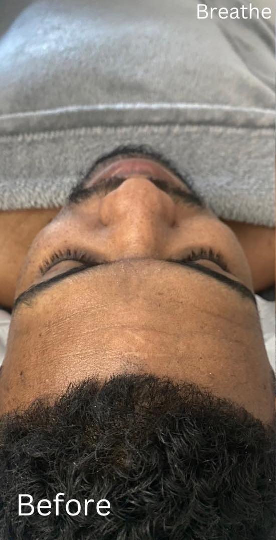 before and after microdermabrasion breathe beauty
