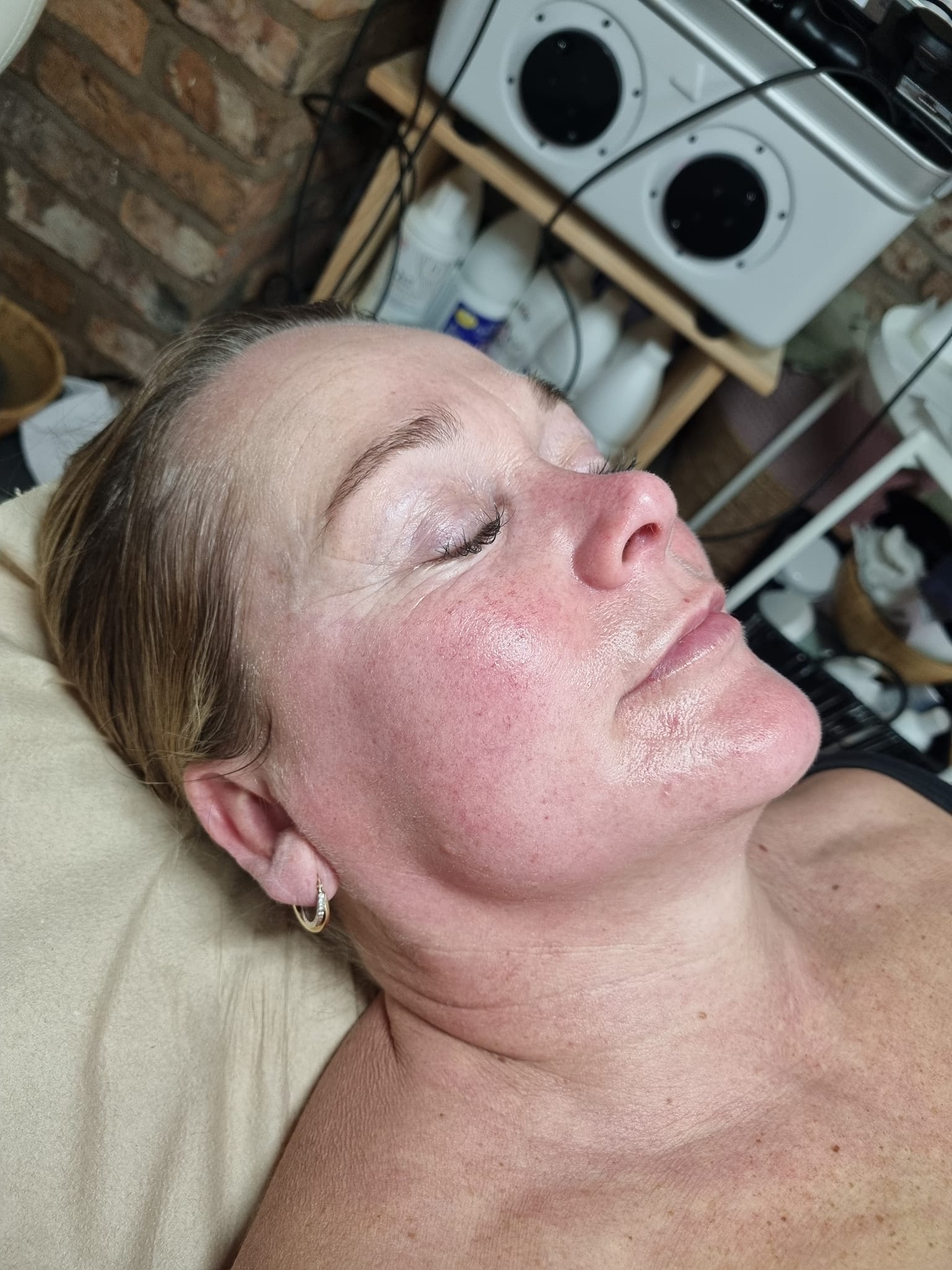 before and after collagen lift danyel noon aesthetics