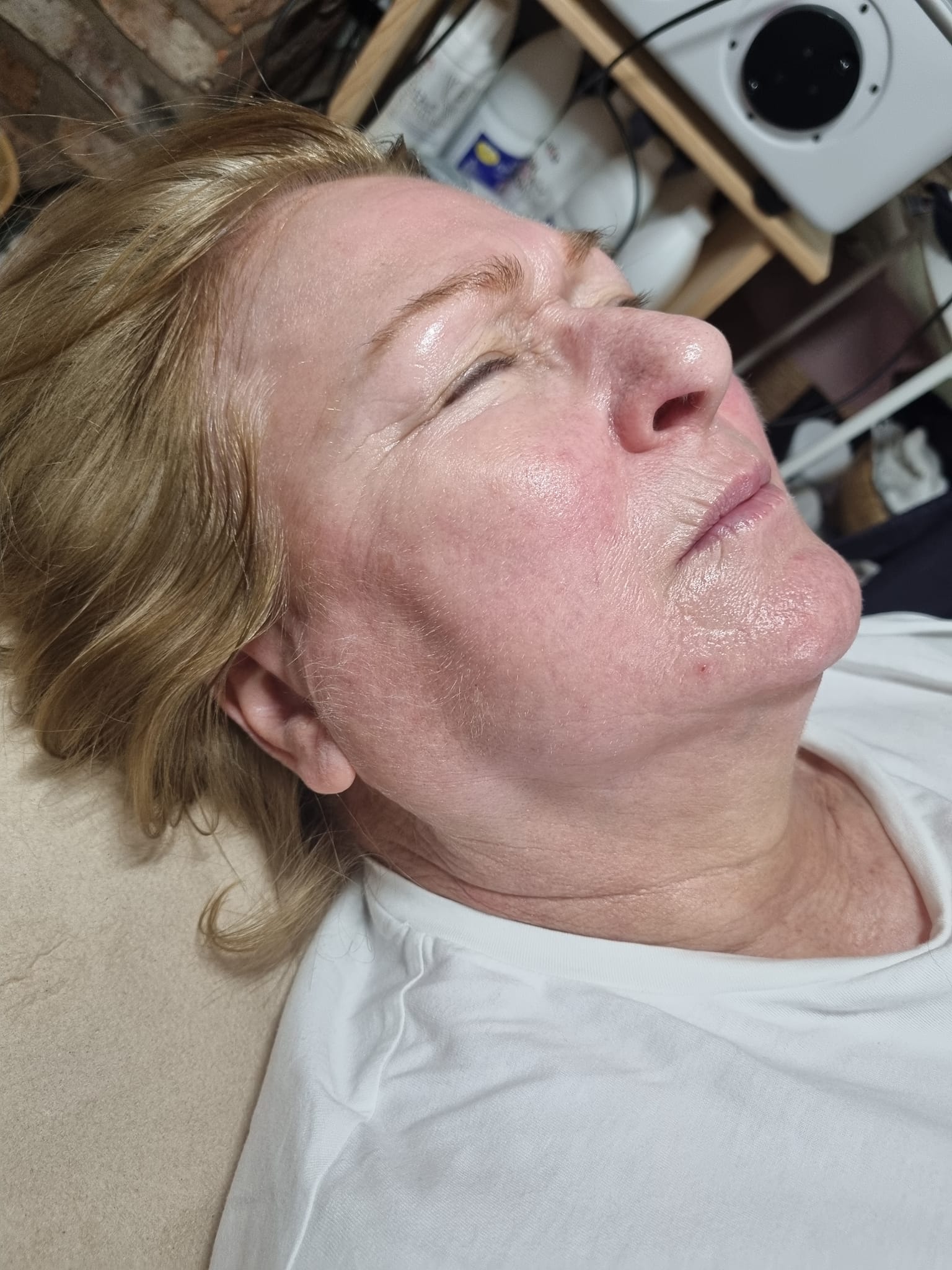 before and after collagen lift danyel noon aesthetics
