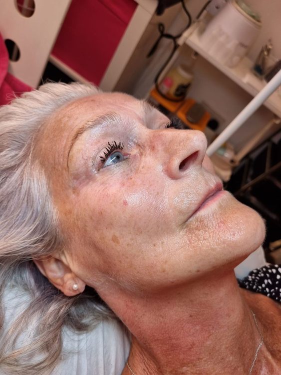 before and after microdermabrasion danyel noon aesthetics