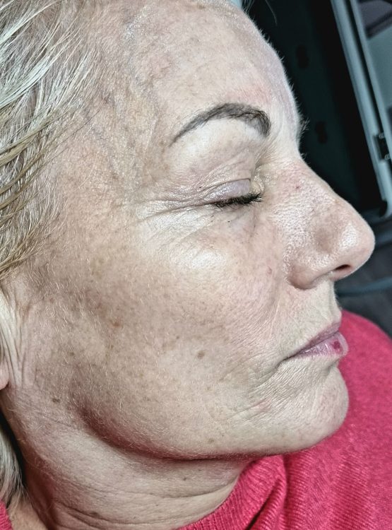 before and after microdermabrasion danyel noon aesthetics
