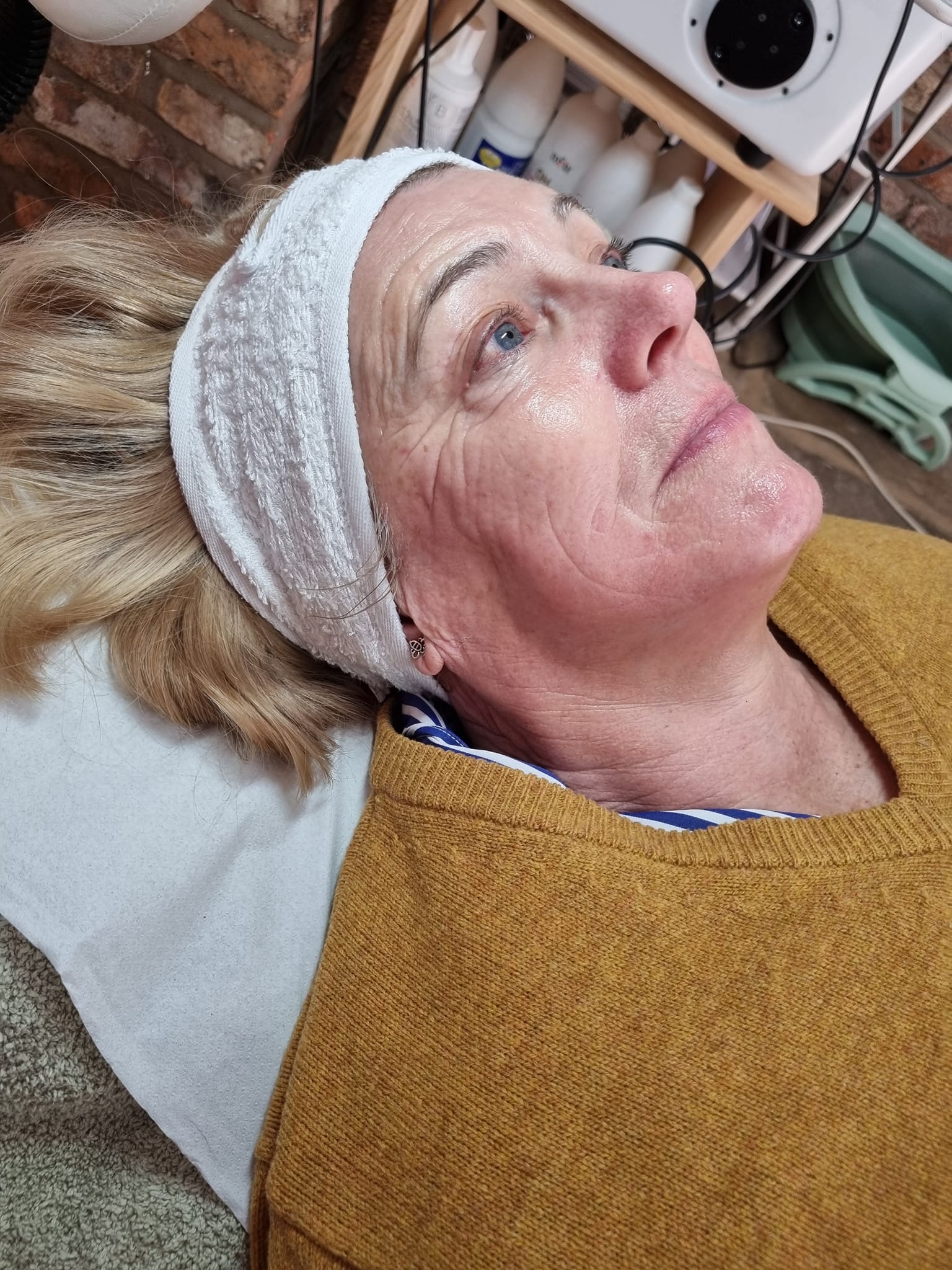 before and after collagen lift danyel noon aesthetics