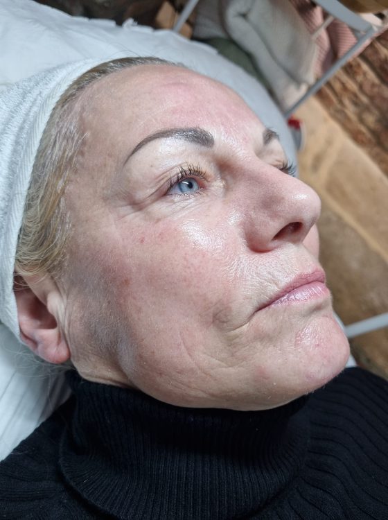 before and after microdermabrasion danyel noon aesthetics