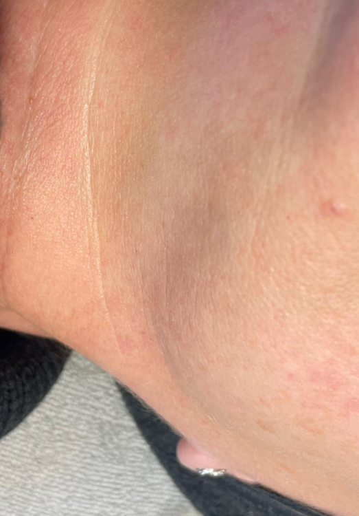 before and after microdermabrasion for pigmentation Emily Barratt