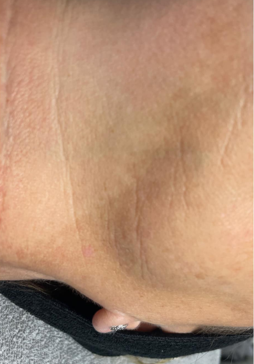 before and after microdermabrasion for pigmentation Emily Barratt