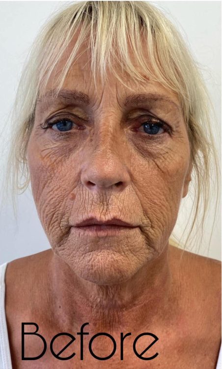 before and after collagen lift the hg aesthetics clinic