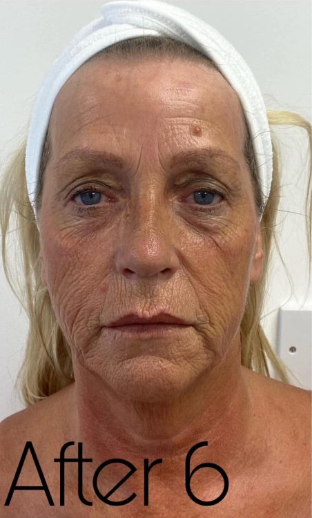 before and after collagen lift the hg aesthetics clinic