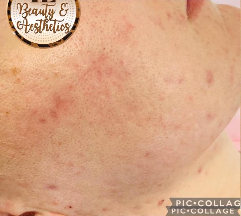 before and after microdermabrasion IE beauty and aesthetics
