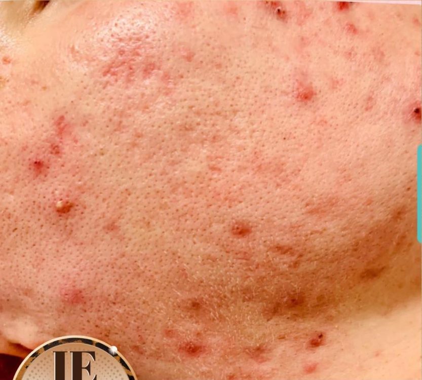 before and after microdermabrasion IE beauty and aesthetics