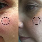 Thread veins – What causes them and is there a way to get rid of them?