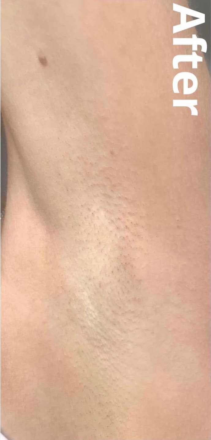 before and after IPL Hair Reduction Jill Norman