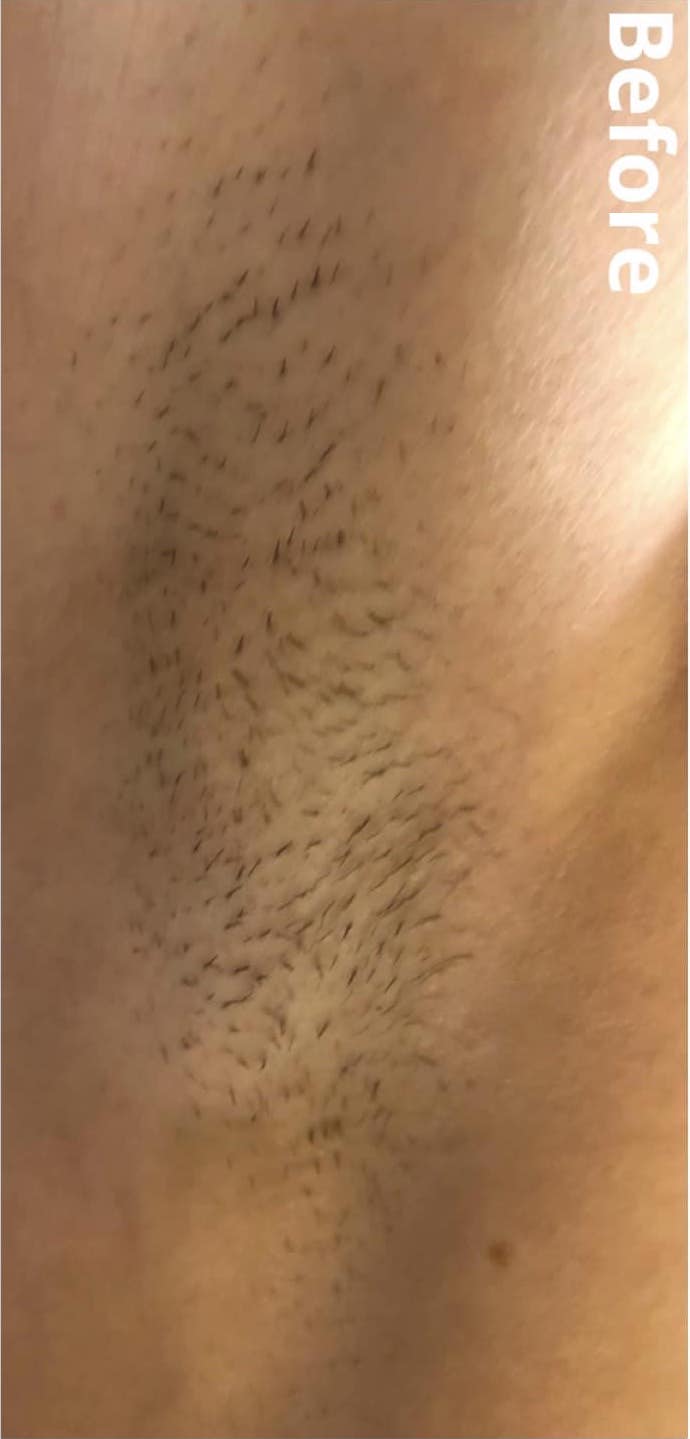 before and after IPL Hair Reduction Jill Norman