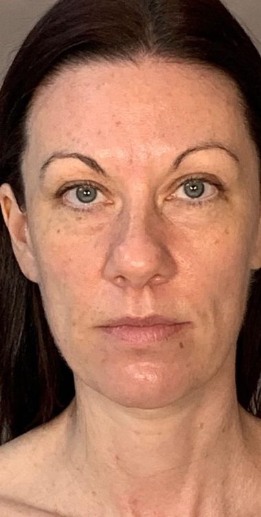 before and after collagen lift jo hannan skin health and transformation