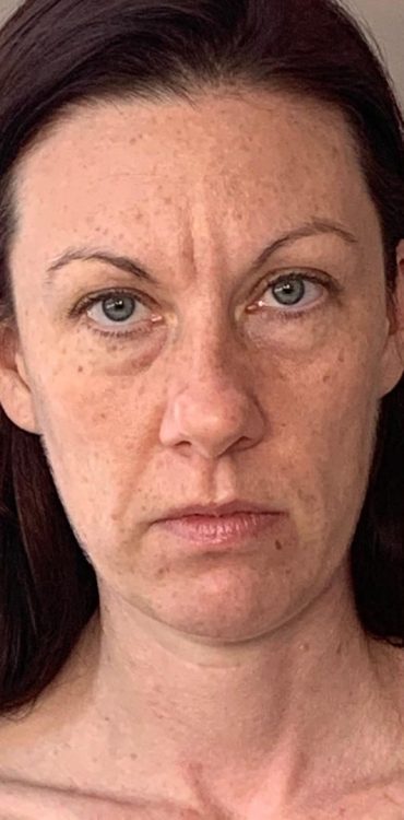 before and after collagen lift jo hannan skin health and transformation