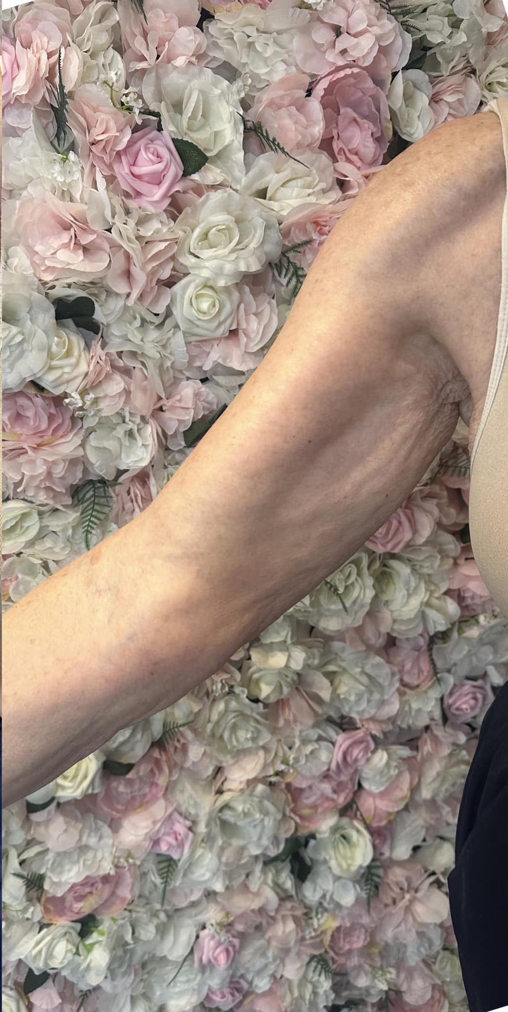 before and after collagen lift Katherine Monique Beauty