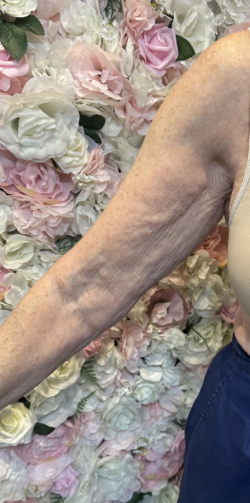 before and after collagen lift Katherine Monique Beauty