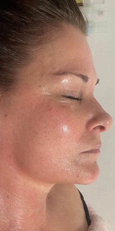 before and after collagen lift Katherine Monique Beauty