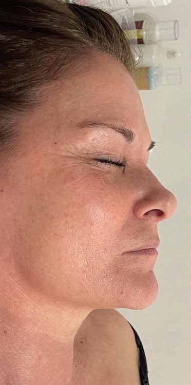 before and after collagen lift Katherine Monique Beauty