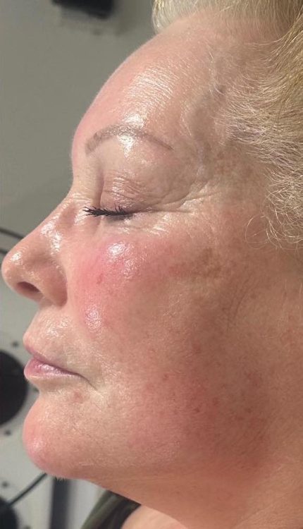 before and after collagen lift Katherine Monique Beauty