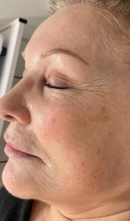 before and after collagen lift Katherine Monique Beauty