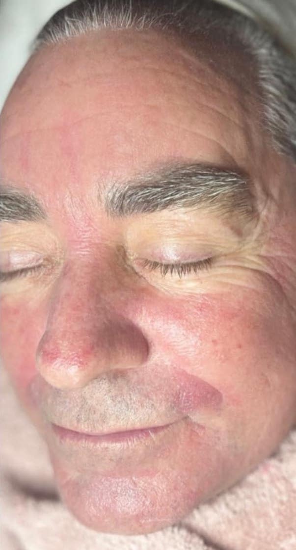 before and after microdermabrasion KG beauty and aesthetics