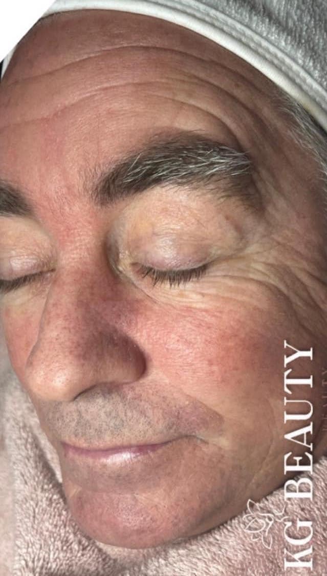 before and after microdermabrasion KG beauty and aesthetics
