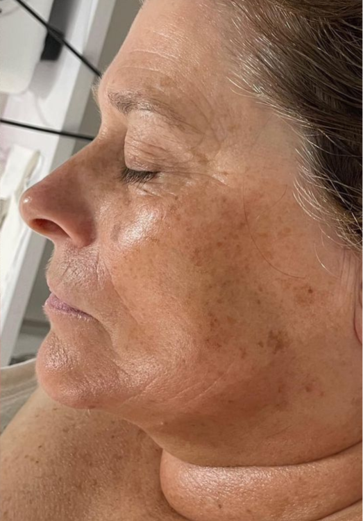 before and after collagen lift for uneven skin tone Katherine Monique Beauty